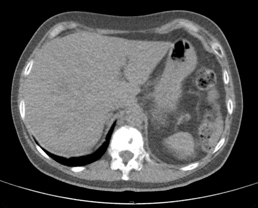 Adenosquamous lung carcinoma (Radiopaedia 22035-22030 non-contrast 56).jpg