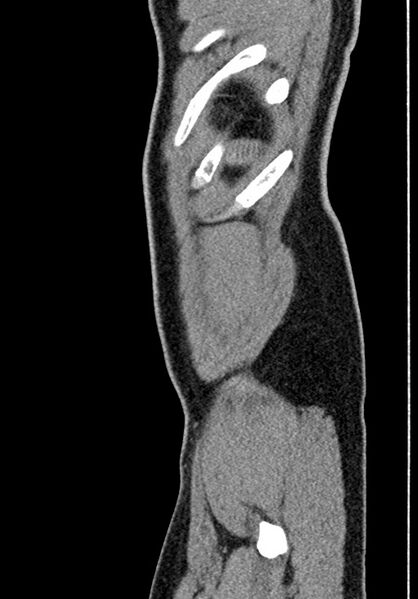 File:Adhesional small bowel obstruction (Radiopaedia 58900-66131 Sagittal C+ portal venous phase 237).jpg