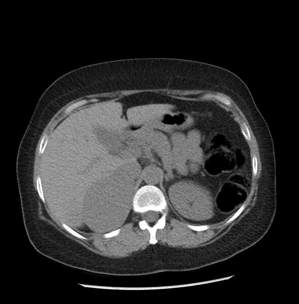 File:Adrenal cortical carcinoma with IVC invasion and thrombosis (Radiopaedia 34307-35597 Axial non-contrast 14).jpg