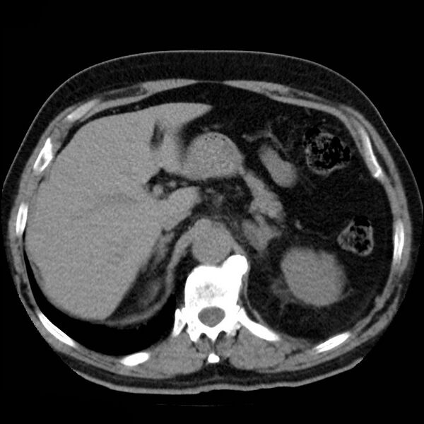 File:Adrenal hemangioma (Radiopaedia 11039-11445 Axial non-contrast 4).jpg