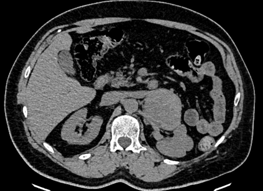 Adrenal metastases (Radiopaedia 73082-83791 Axial non-contrast 66).jpg