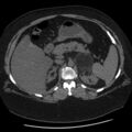 Adrenal myelolipoma (Radiopaedia 8216-9068 Axial non-contrast 15).jpg