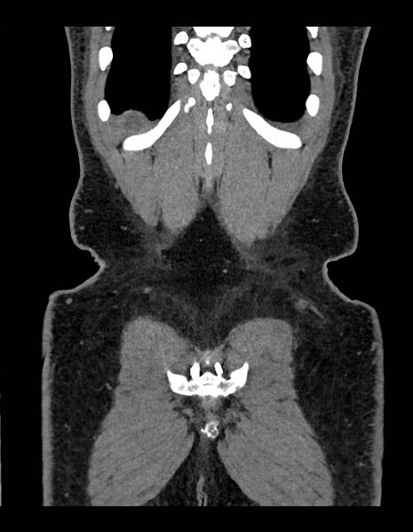 File:Adrenal myelolipoma - bilateral (Radiopaedia 74805-85810 Coronal C+ portal venous phase 60).jpg