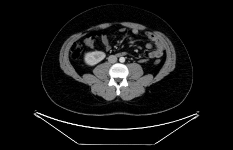 File:Adrenocortical carcinoma (Radiopaedia 80134-93438 Axial C+ portal venous phase 74).jpg
