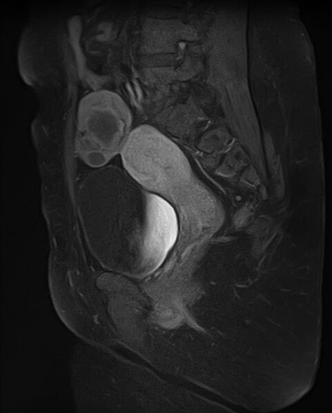 File:Adult granulosa cell tumor of the ovary (Radiopaedia 71581-81950 Sagittal T1 C+ fat sat 15).jpg