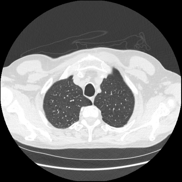 File:Alpha-1-antitrypsin deficiency (Radiopaedia 40993-43722 Axial lung window 29).jpg