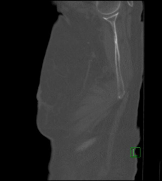 File:Amiodarone deposition in the liver (Radiopaedia 77587-89780 Sagittal bone window 90).jpg