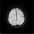 Amnestic syndrome secondary to hypoxic brain injury (Radiopaedia 24743-25004 DWI 24).jpg