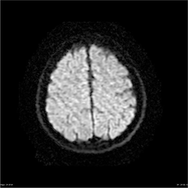 File:Amnestic syndrome secondary to hypoxic brain injury (Radiopaedia 24743-25004 DWI 24).jpg