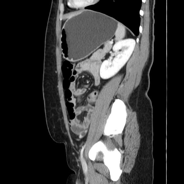 File:Ampullary tumor (Radiopaedia 22787-22816 D 39).jpg