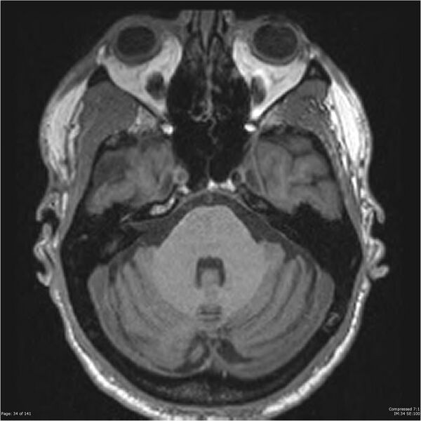 File:Anaplastic meningioma with recurrence (Radiopaedia 34452-35788 Axial T1 32).jpg