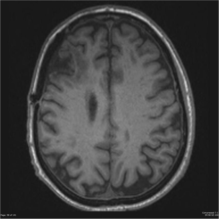 Anaplastic meningioma with recurrence (Radiopaedia 34452-35788 Axial T1 96).jpg