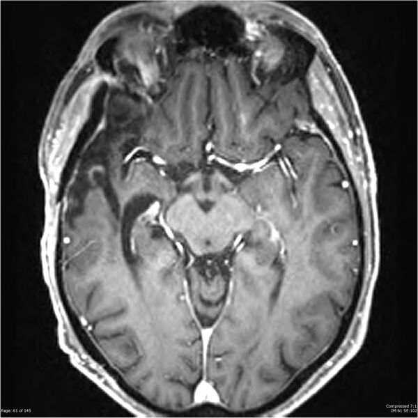 File:Anaplastic meningioma with recurrence (Radiopaedia 34452-35788 Axial T1 C+ 61).jpg