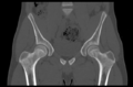 Aneurysmal bone cyst of ischium (Radiopaedia 25957-26094 Coronal bone window 16).png