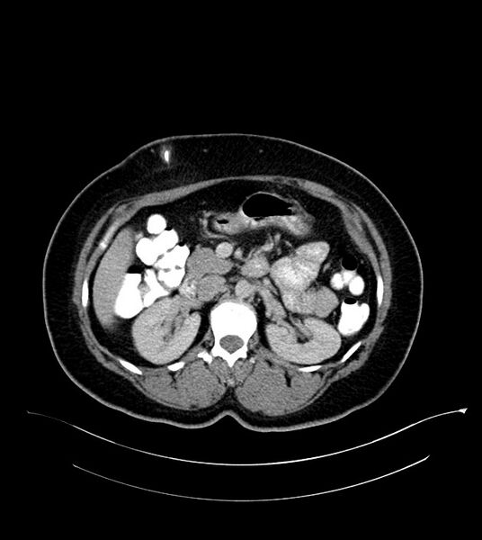 File:Anterior abdominal wall CSF pseudocyst (CSFoma) (Radiopaedia 79453-92571 A 37).jpg
