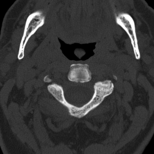 File:Anterior cervical postdiscectomy arthrodesis (Radiopaedia 32678-33646 Axial bone window 22).jpg