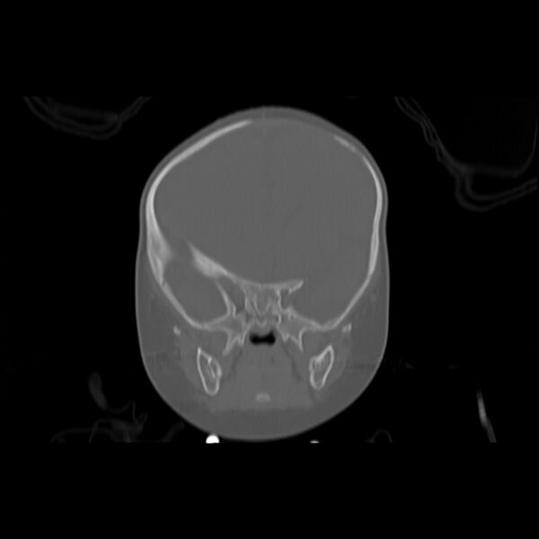 File:Anterior plagiocephaly (Radiopaedia 71836-82273 Coronal bone window 5).jpg
