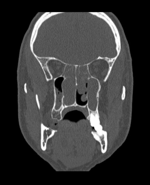 File:Antrochoanal polyp (Radiopaedia 79011-92169 Coronal bone window 39).jpg