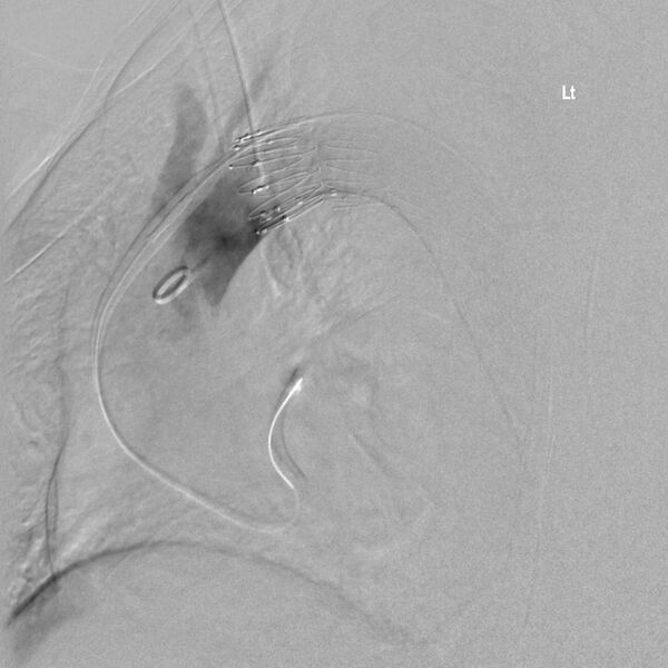 File:Aortic arch false aneurysm (Radiopaedia 14667-14589 Final result 4).jpg