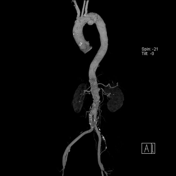 File:Aortic arch saccular aneurysm (Radiopaedia 19430-19457 A 2).jpg