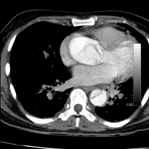File:Aortic dissection - Stanford type A (Radiopaedia 29247-29659 A 48).jpg