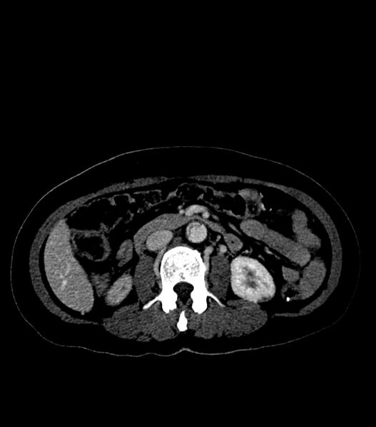 File:Aortic dissection with renal ischemia (Radiopaedia 76573-88338 B 41).jpg