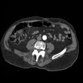 Aortic dissection with rupture into pericardium (Radiopaedia 12384-12647 A 69).jpg