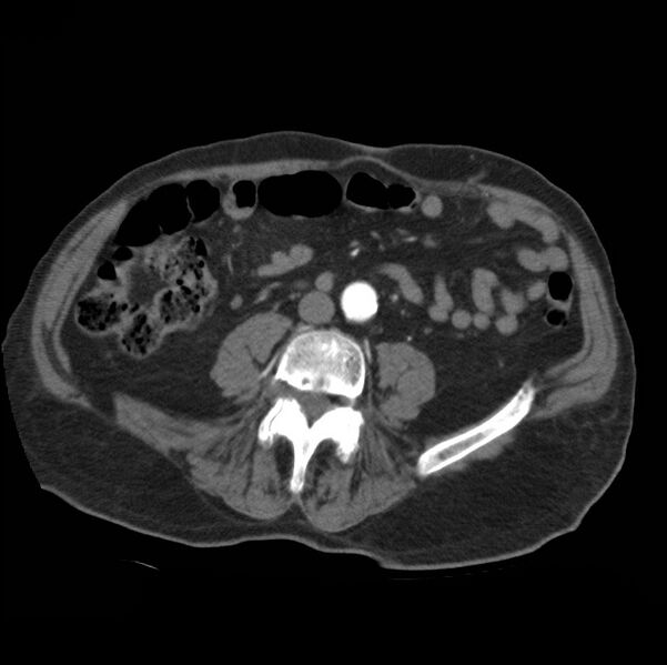 File:Aortic dissection with rupture into pericardium (Radiopaedia 12384-12647 A 69).jpg
