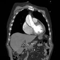 Aortic dissection with rupture into pericardium (Radiopaedia 12384-12647 B 11).jpg