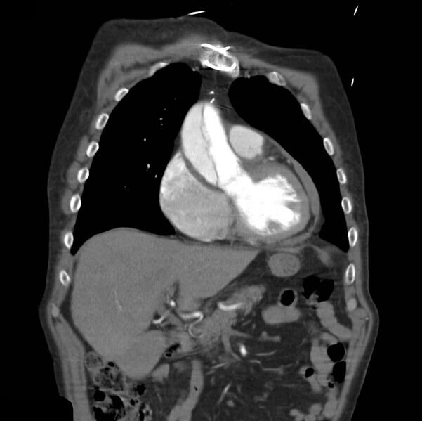 File:Aortic dissection with rupture into pericardium (Radiopaedia 12384-12647 B 11).jpg