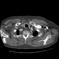Aorto-coronary bypass graft aneurysms (Radiopaedia 40562-43157 A 15).png