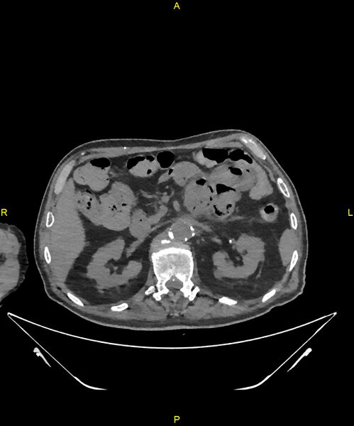 File:Aortoenteric fistula (Radiopaedia 84308-99603 Axial non-contrast 106).jpg