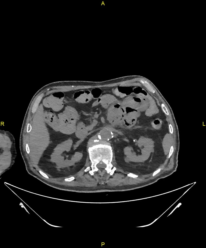 Aortoenteric fistula (Radiopaedia 84308-99603 Axial non-contrast 106).jpg