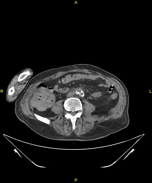 File:Aortoenteric fistula (Radiopaedia 84308-99603 Axial non-contrast 223).jpg