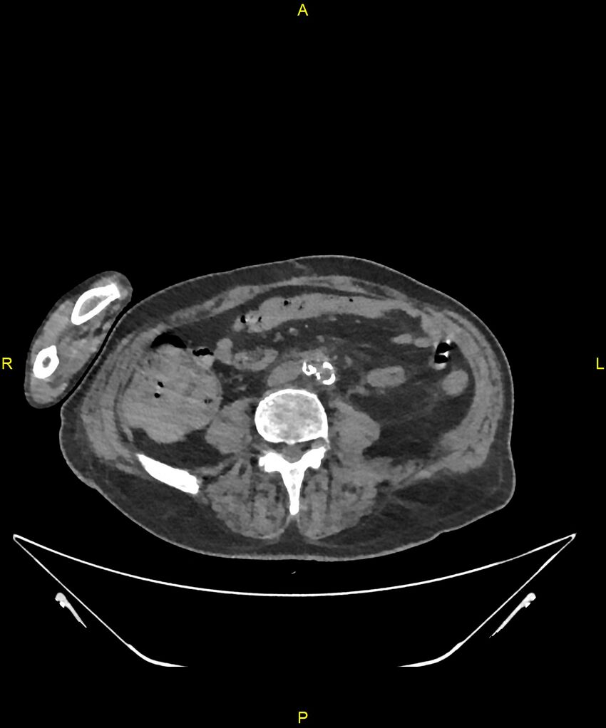 Aortoenteric fistula (Radiopaedia 84308-99603 Axial non-contrast 223).jpg