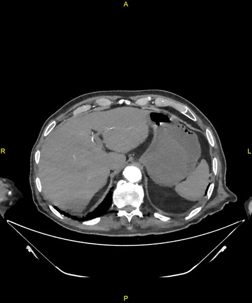 File:Aortoenteric fistula (Radiopaedia 84308-99603 B 47).jpg