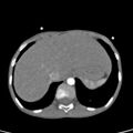 Aortopulmonary window, interrupted aortic arch and large PDA giving the descending aorta (Radiopaedia 35573-37074 B 85).jpg