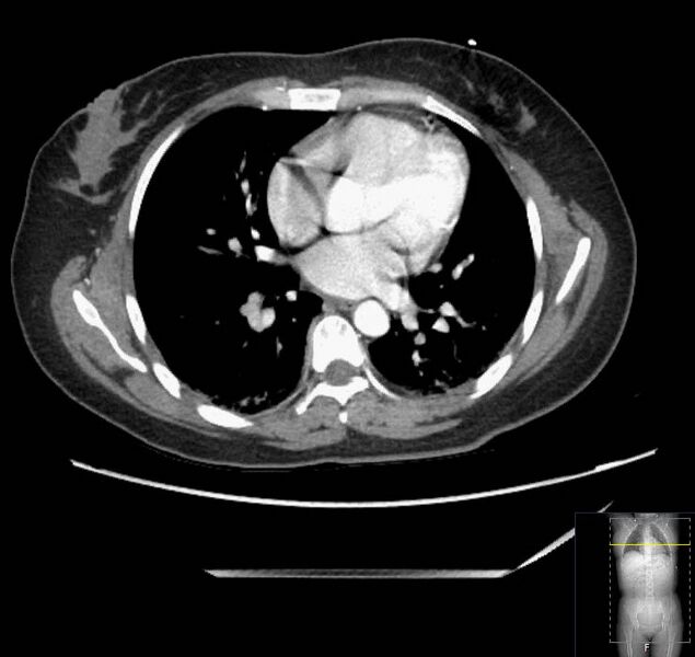 File:Appendicitis (CT angiogram) (Radiopaedia 154713-127660 Axial 195).jpg