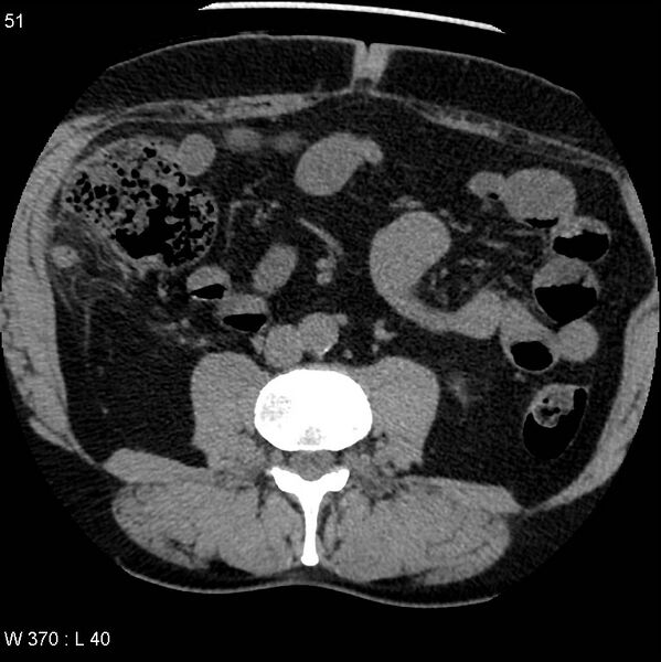 File:Appendicitis (Radiopaedia 12510-12733 Axial non-contrast 18).jpg