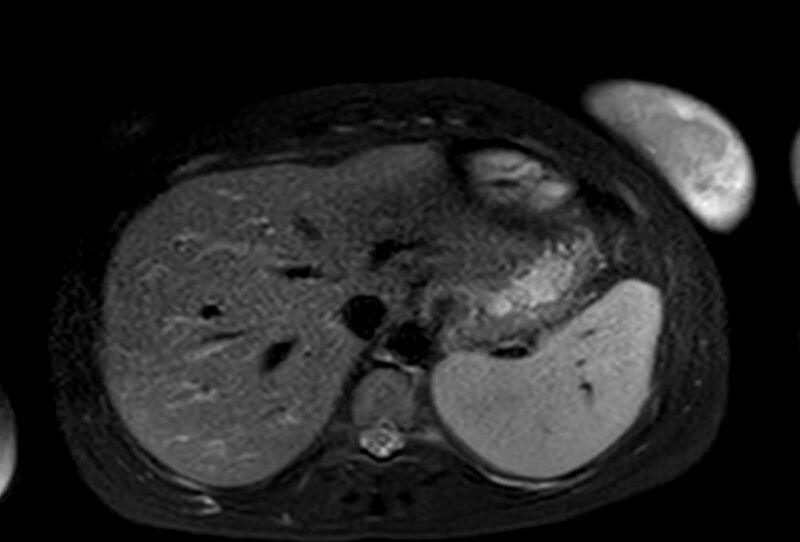 File:Appendicitis in gravida (MRI) (Radiopaedia 89433-106395 Axial T2 SPAIR 11).jpg