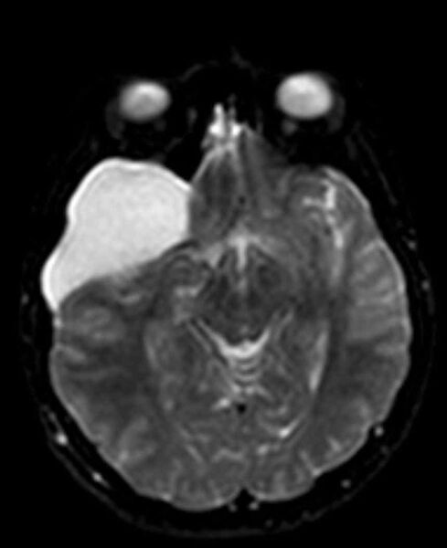 File:Arachnoid cyst- extremely large (Radiopaedia 68741-78451 Axial DWI 11).jpg