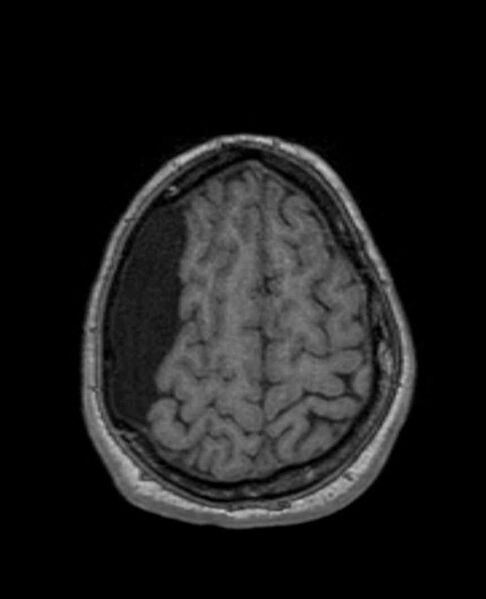 File:Arachnoid cyst- extremely large (Radiopaedia 68741-78451 Axial T1 66).jpg