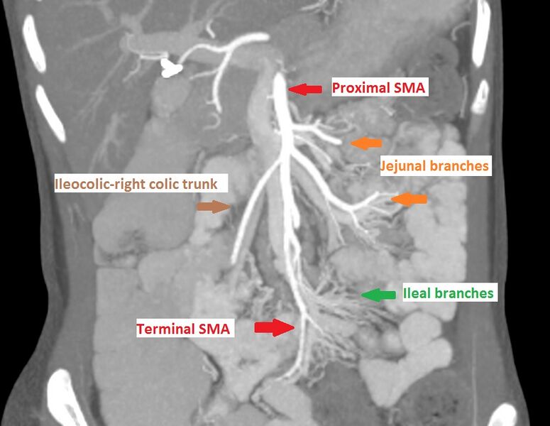 File:Arterial occlusive mesenteric ischemia (Radiopaedia 84641-100062 A 1).jpg