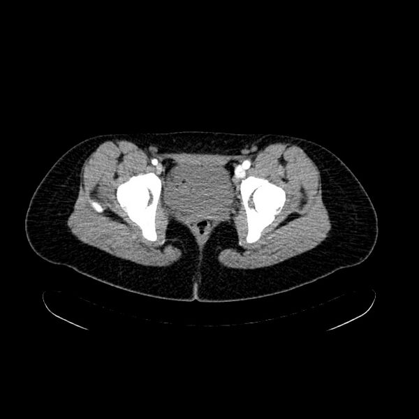 File:Arteriovenous malformation - thigh (Radiopaedia 14948-14883 Axial 71).jpg