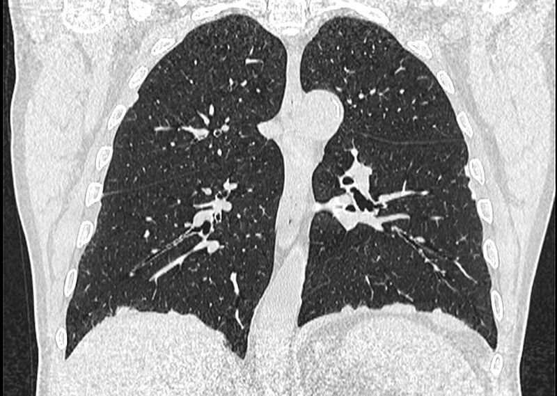 File:Asbestos pleural placques (Radiopaedia 57905-64872 Coronal lung window 177).jpg