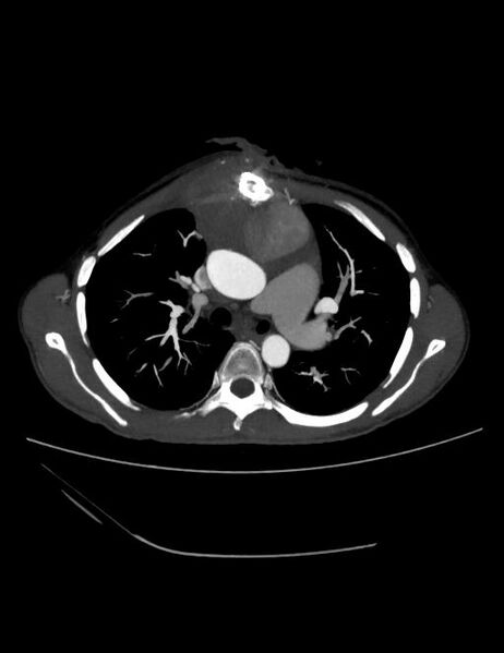File:Ascending aortic pseudoaneurysm (Radiopaedia 28638-28910 A 9).jpg
