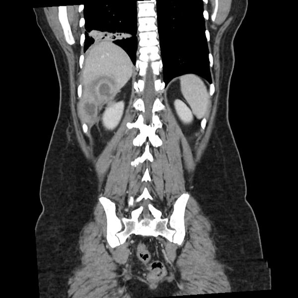 File:Ascending retrocecal appendicitis with liver abscesses (Radiopaedia 60066-67615 C 3).jpg