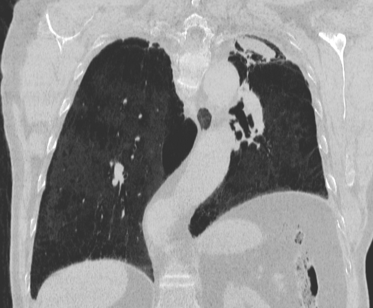 File:Aspergilloma (Radiopaedia 24521-24804 Coronal lung window 1).png