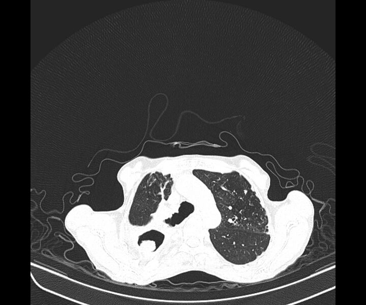 File:Aspergillomas (Radiopaedia 66779-76110 Axial lung window 18).jpg