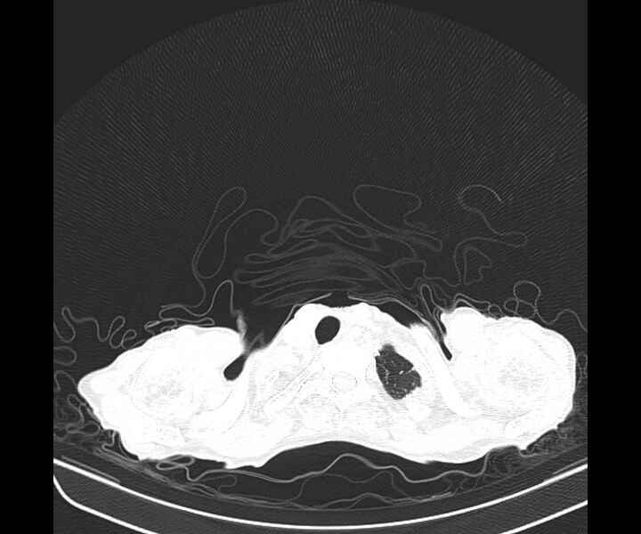 File:Aspergillomas (Radiopaedia 66779-76110 Axial lung window 8).jpg